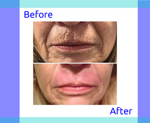 Plasma Fibroblast at the Letchworth Clinic