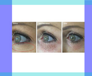 Plasma Fibroblast at the Letchworth Clinic