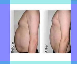Lipo-Cavitation at the Letchworth Clinic